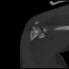 SPORK, NICO - 22.03.1976 - 02.08.2022 - CT obere Extremität - 17:59:07